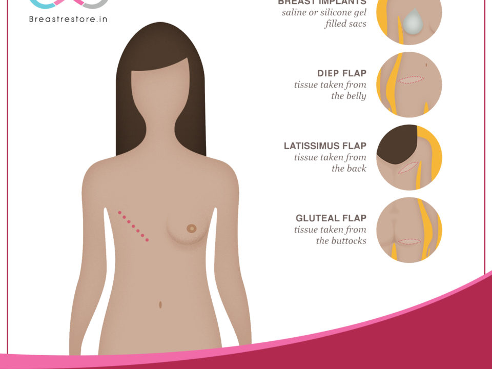 Types of Breast Reconstruction by Breast Restore